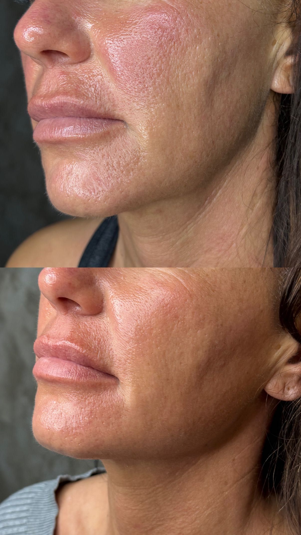 Efekty zabiegu na twarz - przed i po