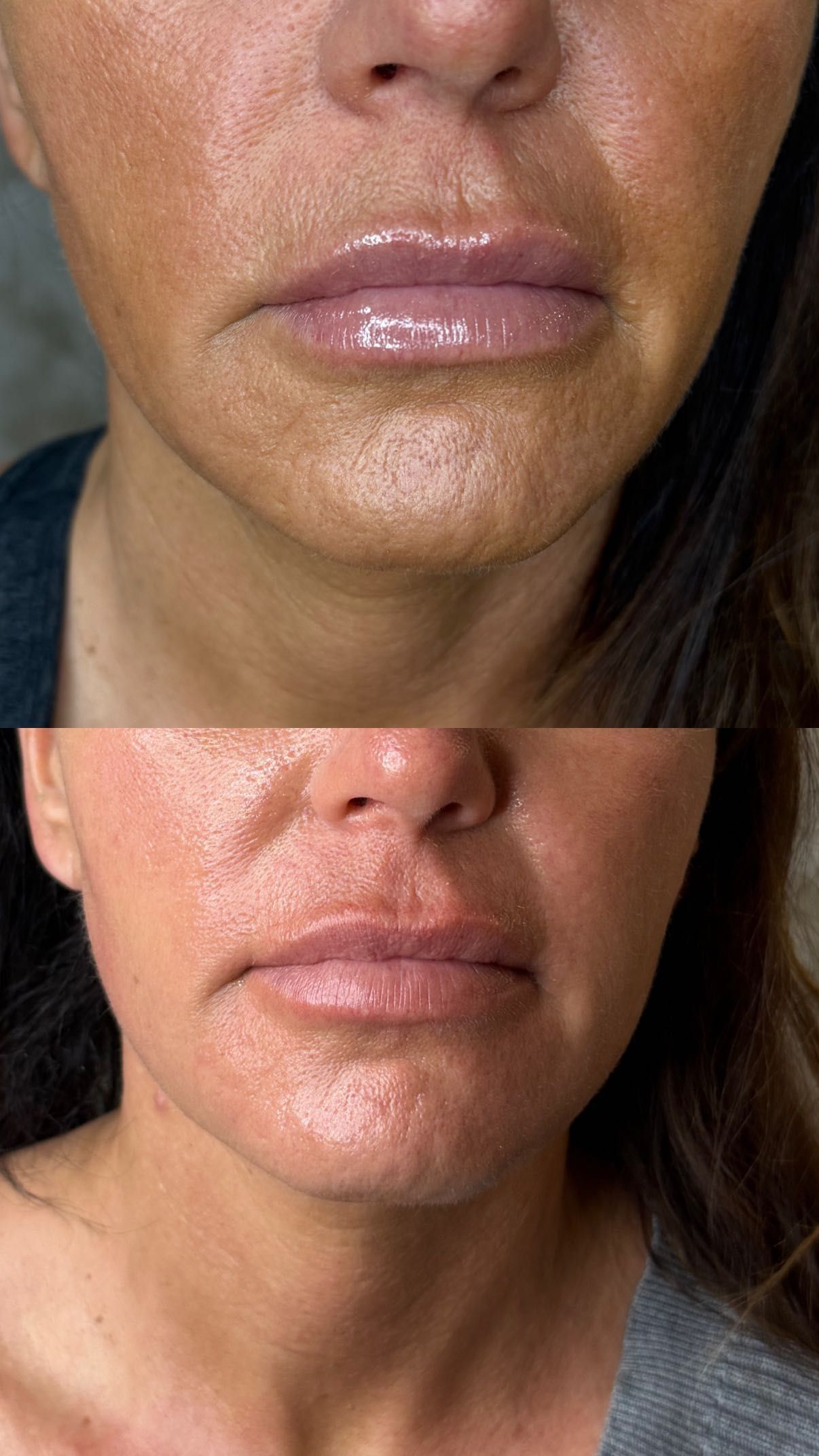 Lifting twarzy - efekty zabiegu